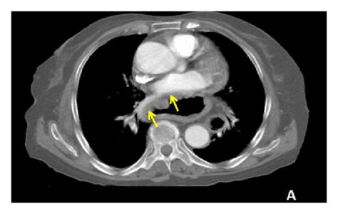 Axial and coronal images of the hiatal hernia on thoracoabdominal CT... | Download Scientific ...