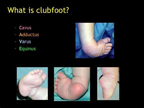 Clubfoot / CTEV ... (*) CAVE | Ortho, Orthopedics