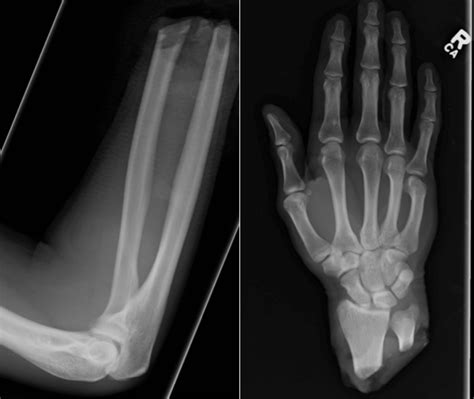 Traumatic amputation - Radiology at St. Vincent's University Hospital