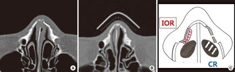 Case of depressed lateral nasal bone fracture (A) CT scan view of nasal ...