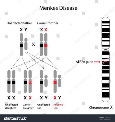 Menkes Disease Mnk Genetics Stock Illustration 149230211 | Shutterstock