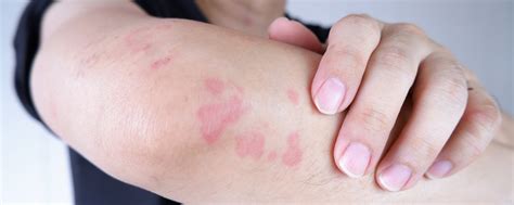 Urticaria Treatment