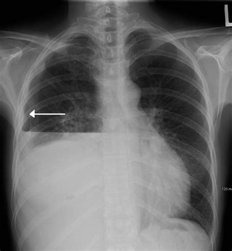 Hydropneumothorax - Wikipedia