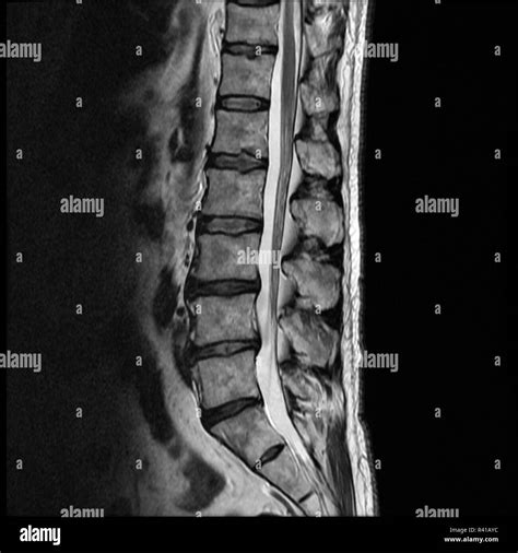 Herniated Disc Mri Spine