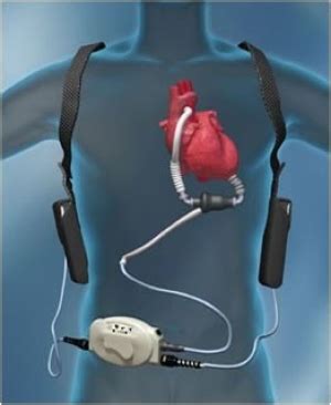 LVAD & Kidney Dysfunction: The Chicken & the Egg - Renal Fellow Network