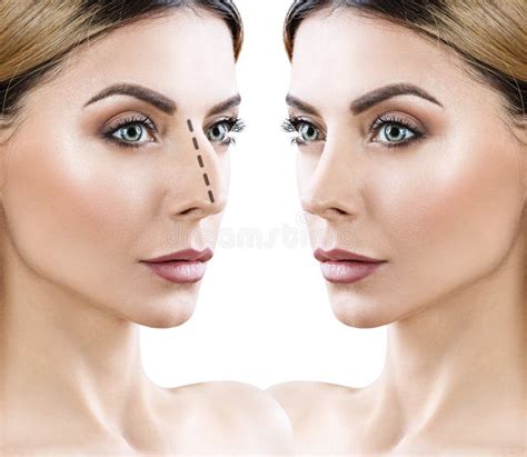 Female Nose before and after Cosmetic Surgery. Stock Image - Image of contour, lines: 106192265