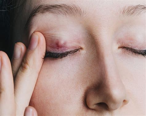 Chalazion: All your questions answered! - Oculase