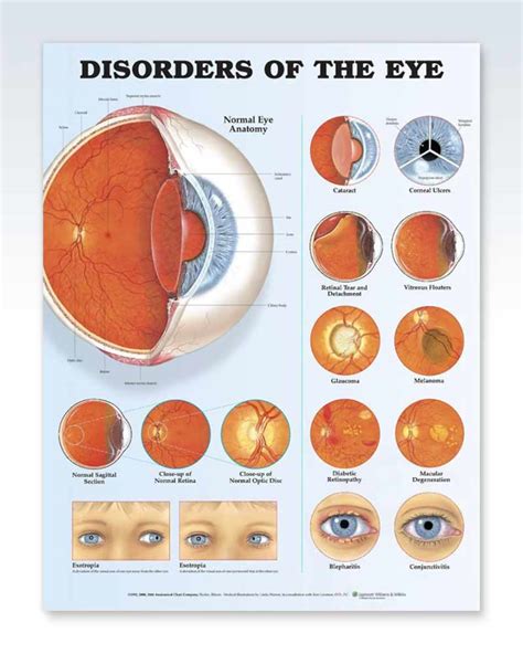 Disorders of the Eye Exam Room Anatomy Poster – ClinicalPosters