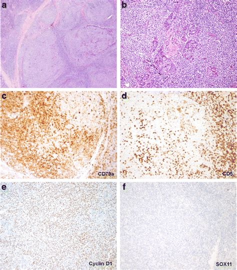 Histology and immunohistochemistry of CD5-negative mantle cell ...