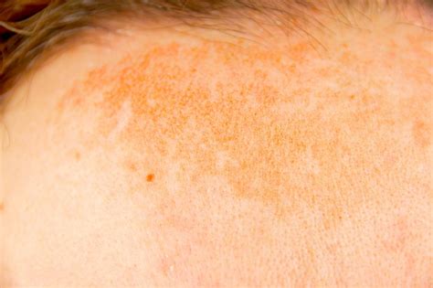 Hyperpigmentation: Treatment, types, and causes - Richmond Hill ...