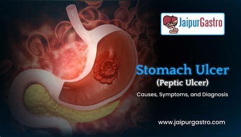 Stomach Ulcer (Peptic ulcer)