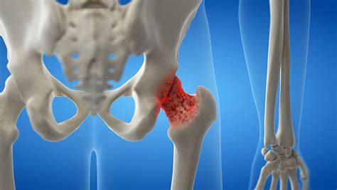 Physical Therapy Guide to Osteoporosis - Elevate Physical Therapy