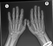 gout | Search | Radiopaedia.org