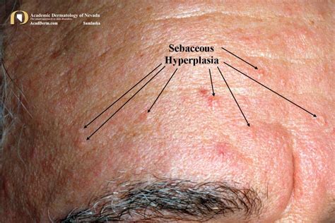 Sebaceous Hyperplasia: Tiny Yellow Donuts... - Academic Dermatology of ...