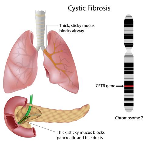 Cystic Fibrosis- Pathophysiology -Managment- TeachMePaediatrics