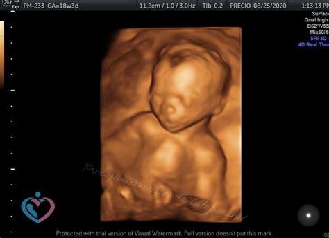 Pregnancy Ultrasound Image Gallery - 17 - 24 Weeks