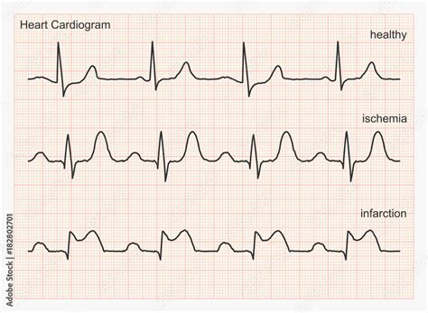 Heart Rhythm Chart