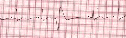 Premature ventricular contractions