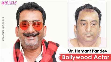 Bollywood Actor – Hemant Pandey Hair Transplant Results