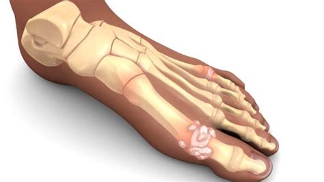 Stiff Big Toe Joint Pain Number Three | Consulting Footpain