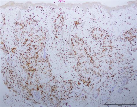 Indeterminate cell histiocytosis | Dermatopathology