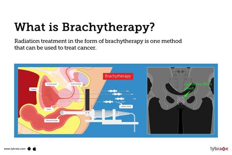 Brachytherapy: Causes, Symptoms, Treatment and Cost