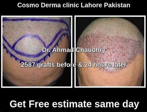 Best hair restoration surgery Lahore | 2587 grafts photos | Free estimate