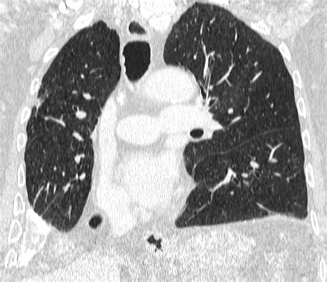 What Are Lung Nodules On Ct Scan Ct Scan Machine