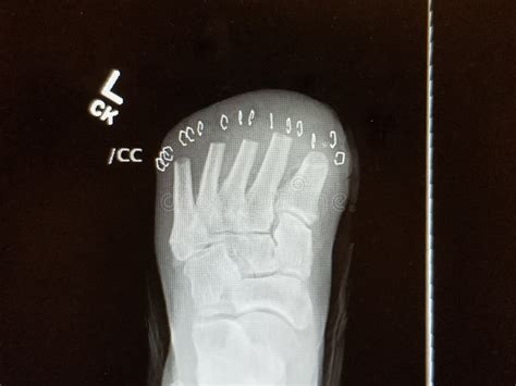 Left Foot Transmetatarsal Amputation with Staples - Plain X-ray Stock Image - Image of radiology ...