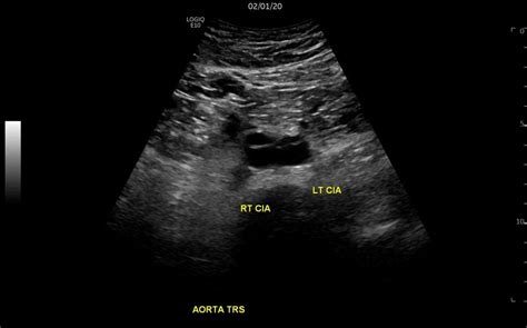 Aortic Dissection – Not something you see every day! – Integrated ...