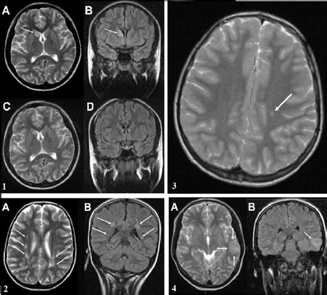 (A,B) A hyperintense lesion within the right caudate nuclei is observed... | Download Scientific ...