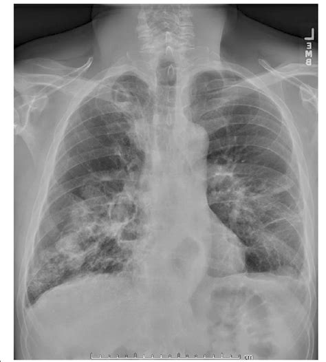 Bronchiectasis Chest X Ray