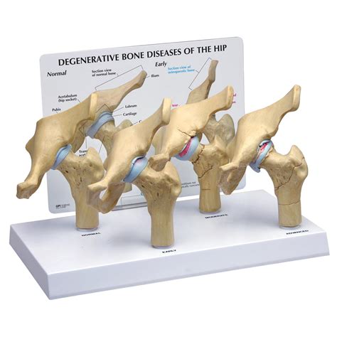 4-Stage Degenerative Bone Diseases of the Hip Model - SEM Trainers