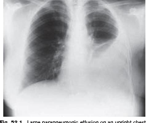 Life Expectancy Mesothelioma Patients