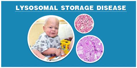 Lysosomal storage disease - Symptoms, Causes, Treatment and types.