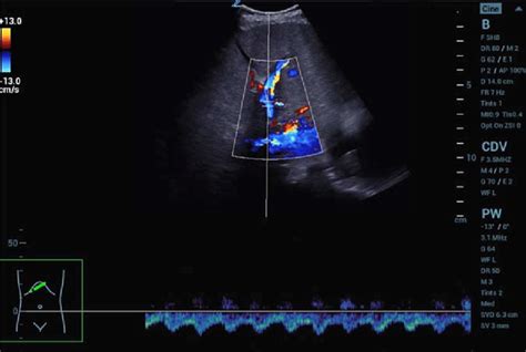 Portal Vein Measurement Ultrasound