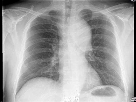 Dissection Chest X Ray | SexiezPicz Web Porn