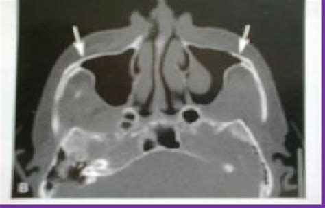 Axial CT image showed pneumatization of the zygomatic process of ...