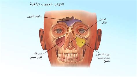 التهاب الجيوب الأنفية الحاد.. يتسبَّب في صداع وألم نابض في الوجه