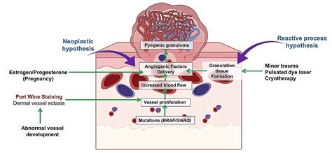 Cureus | An Uncommon Presentation of Pyogenic Granuloma