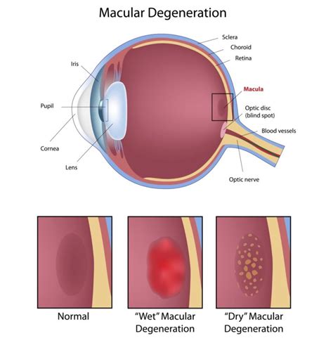 Age-Related Macular Degeneration - Retina Vitreous Consultants, Inc