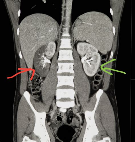 #Abdomen #CT shows #blood flow blocked to the #kidney (red: #renal #infarct). Green is normal. # ...