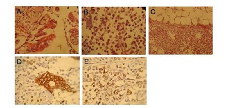 A. Mucinous borderline tumor with intraepithelial carcinoma (H&E stain ...