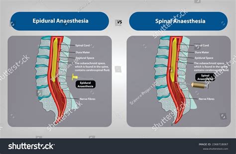 Spinal Anesthesia: Over 257 Royalty-Free Licensable Stock Vectors & Vector Art | Shutterstock