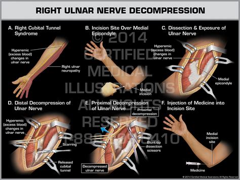 Right Ulnar Nerve Transposition Surgery