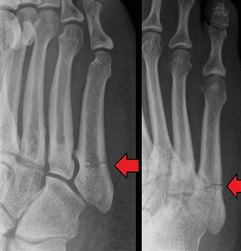 Jones Fracture - Footcare Friday: Alpine Orthopedics and Sports Medicine: Orthopedic Surgery