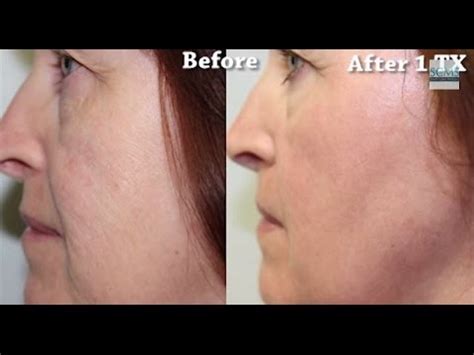 Laser Wrinkle Removal! - YouTube