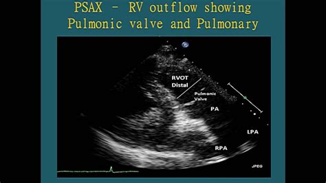 Normal Views - Transthoracic Echocardiogram (TTE) - YouTube