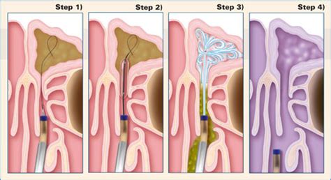 NOSE | Assoc.Prof.Dr.Mete İNANÇLI