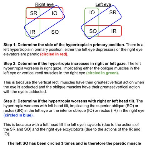 Fourth nerve palsy – Case-Based Neuro-Ophthalmology